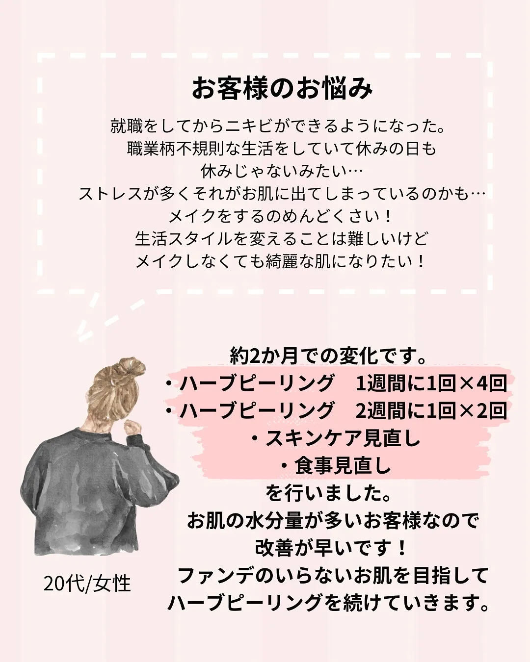 不規則な生活でニキビ爆誕…💣