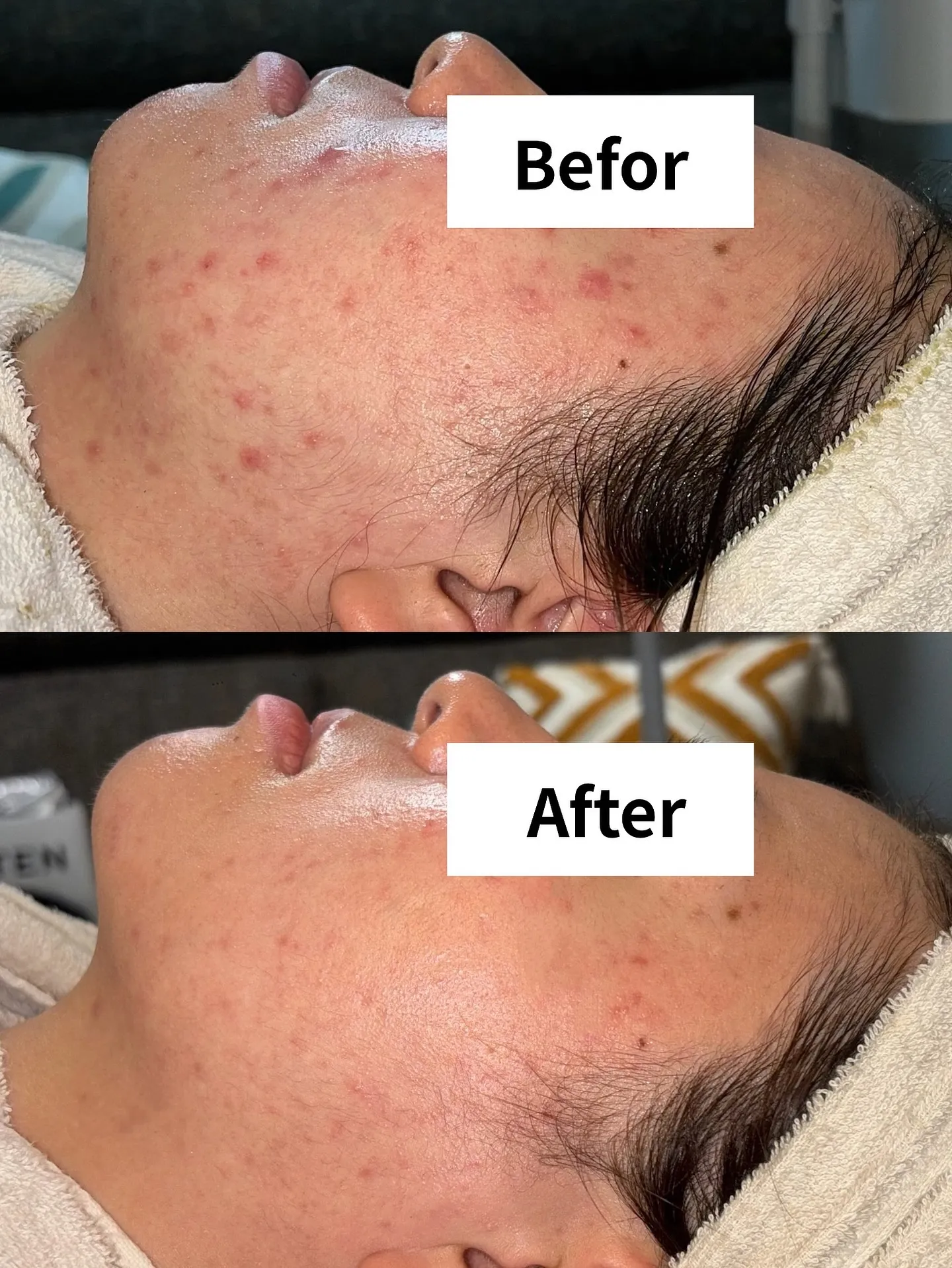 たまご肌コース約7ヶ月での変化です🥚