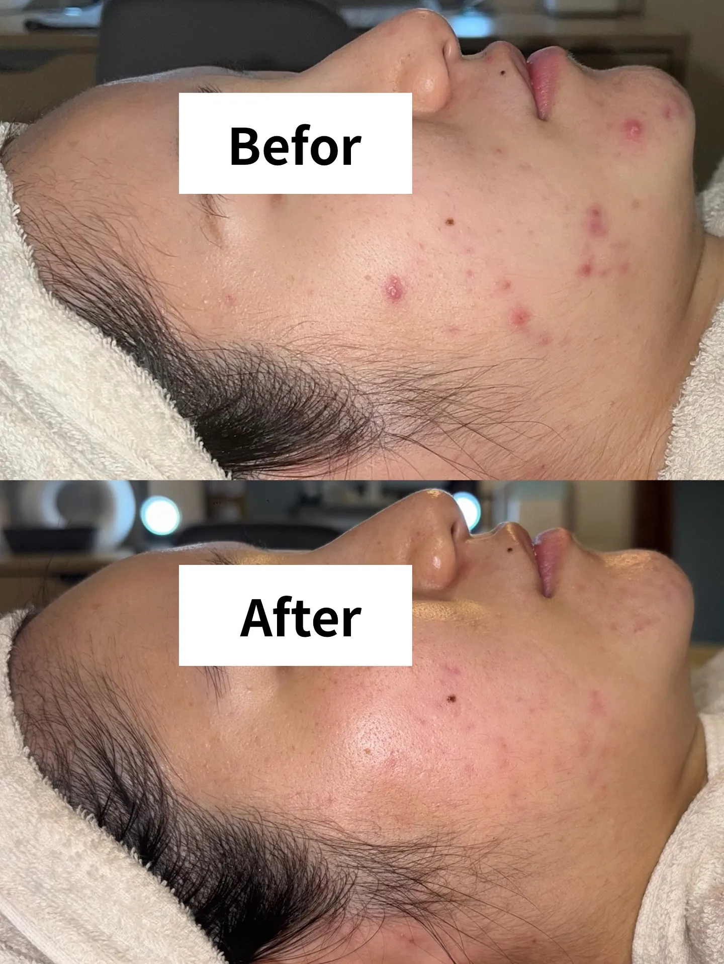 就職を機に出来始めたニキビにお悩みの女性