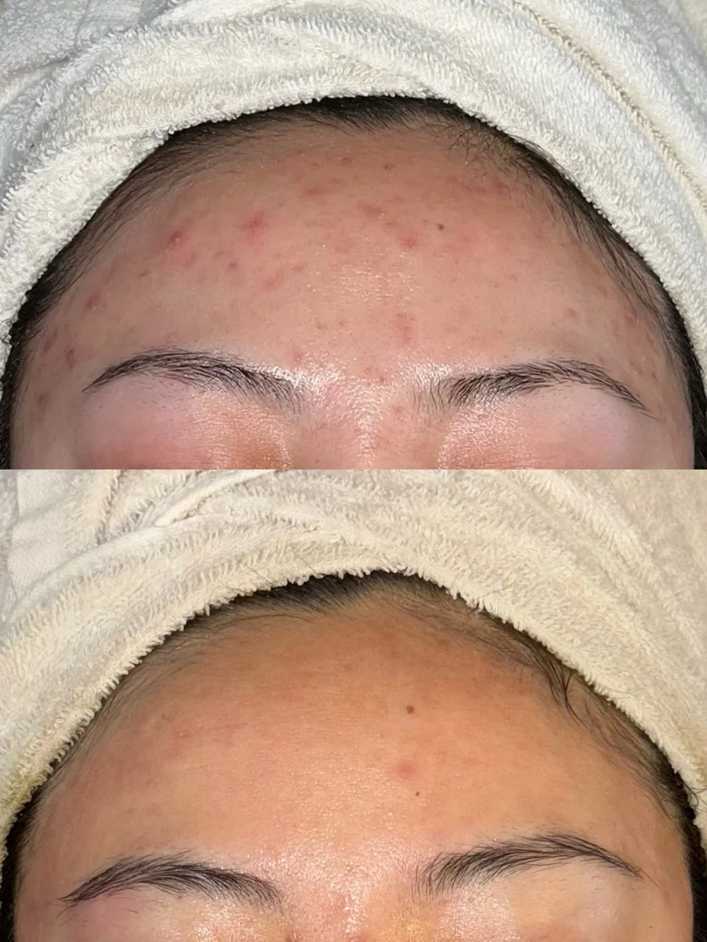 おでこBeforeAfter✨