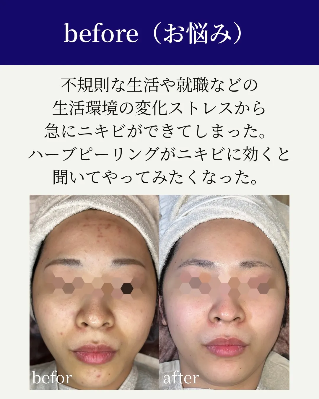 気がついたらニキビが消えていた…