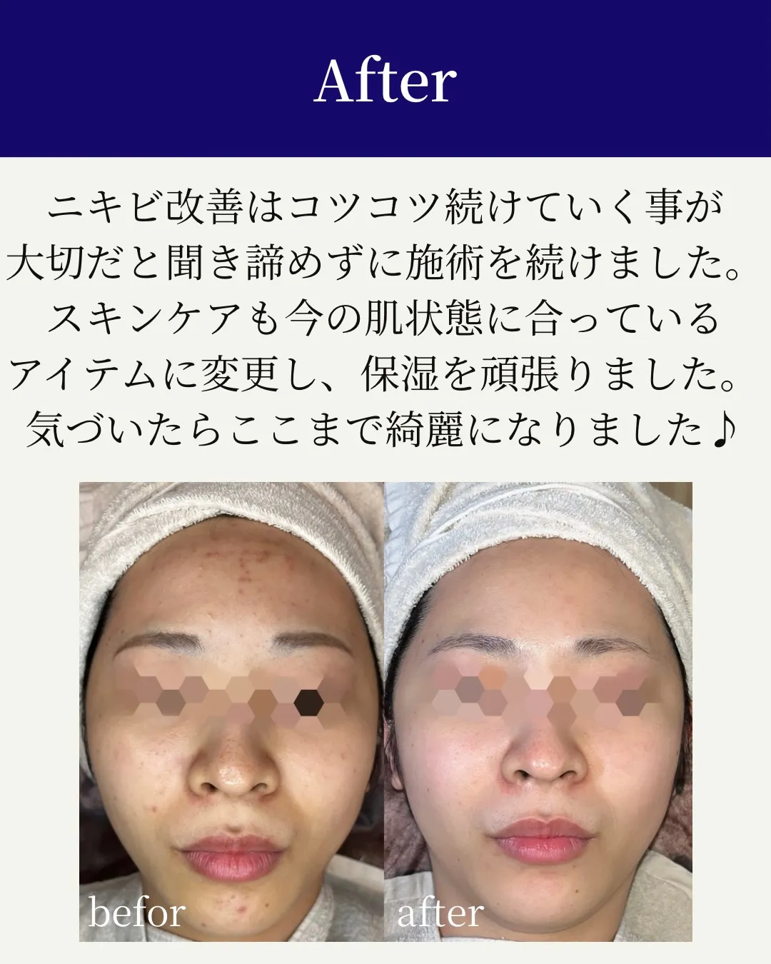 気がついたらニキビが消えていた…