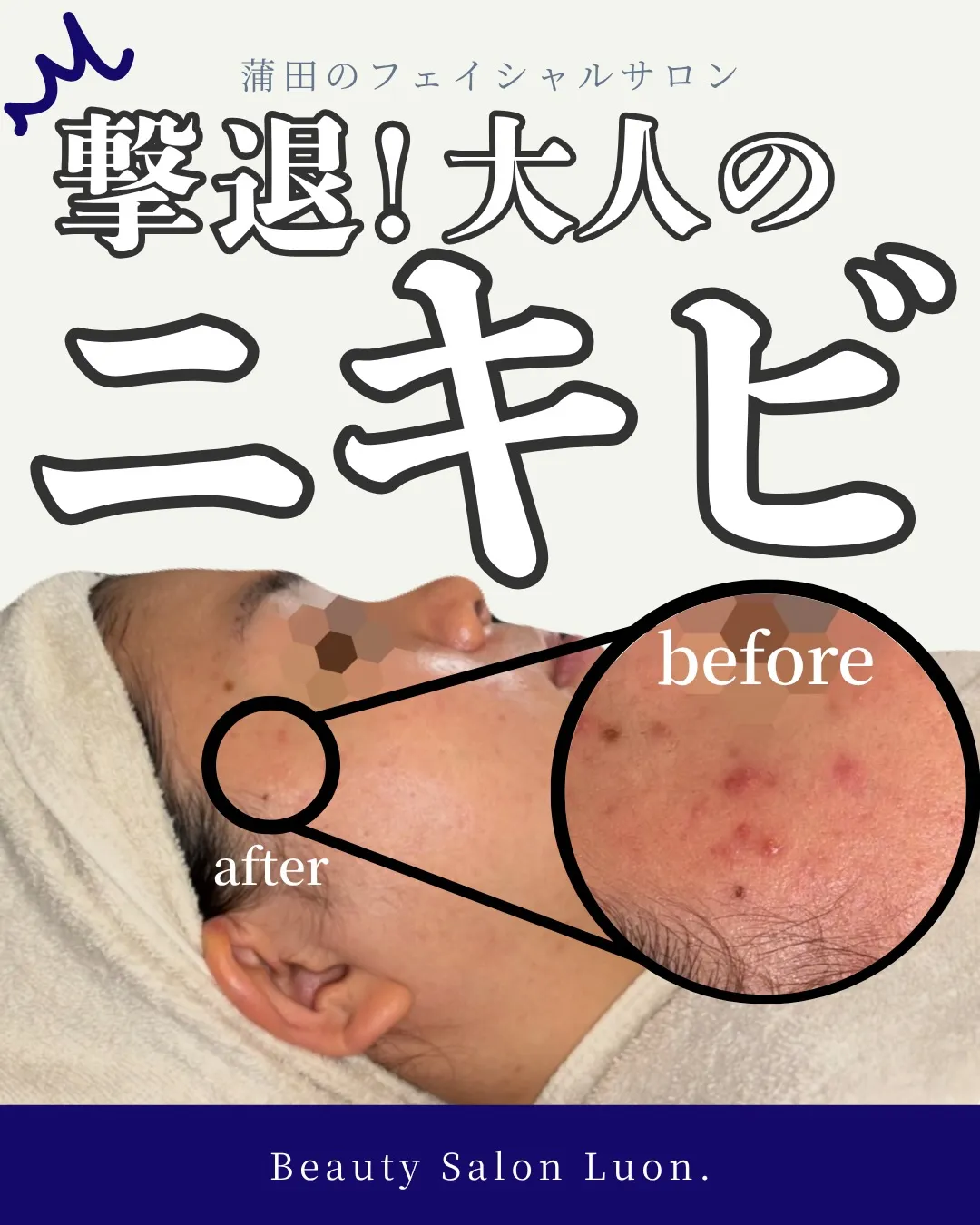 学生時代からニキビで悩むお客様BeforeAfter🪞