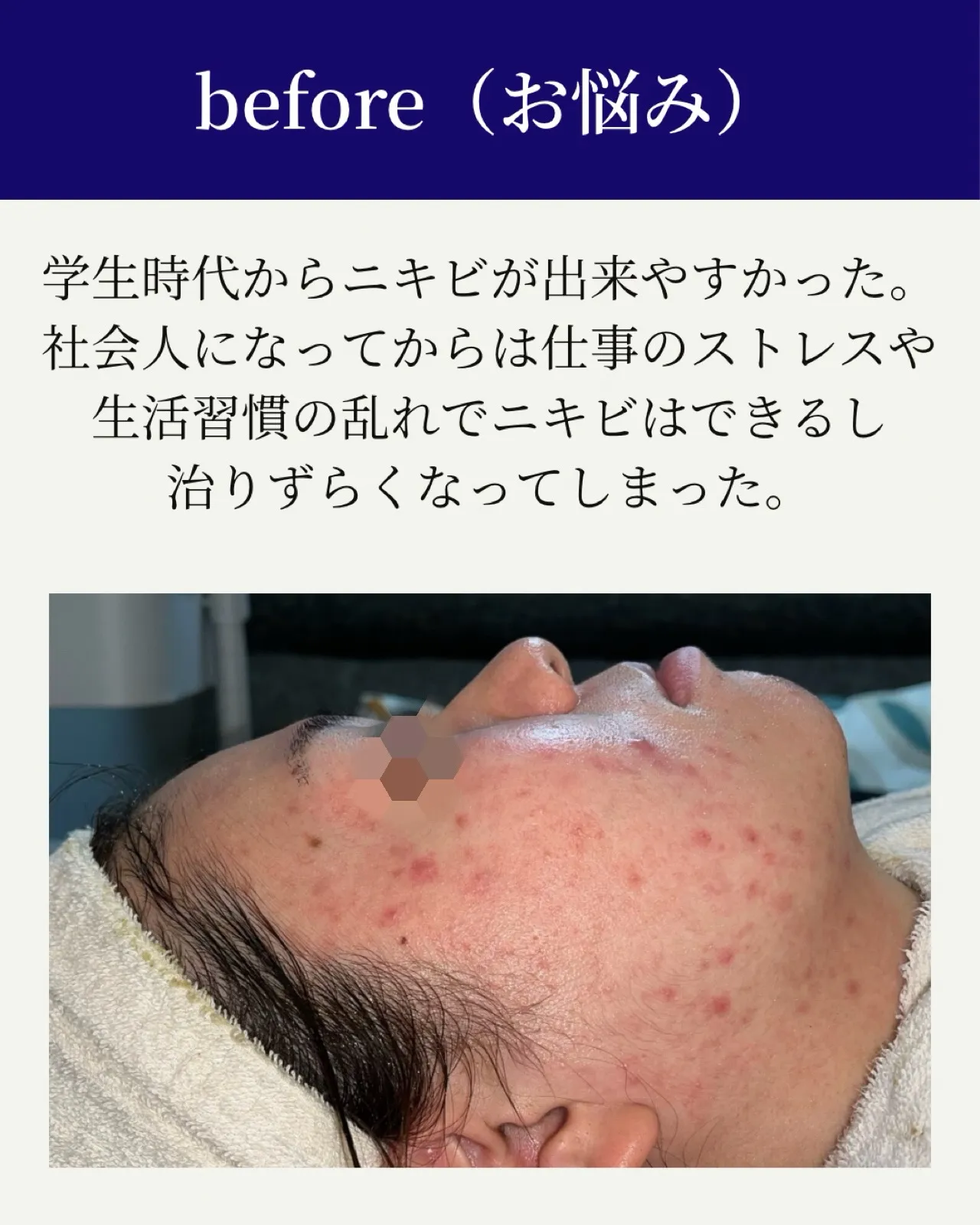 学生時代からニキビで悩むお客様BeforeAfter🪞