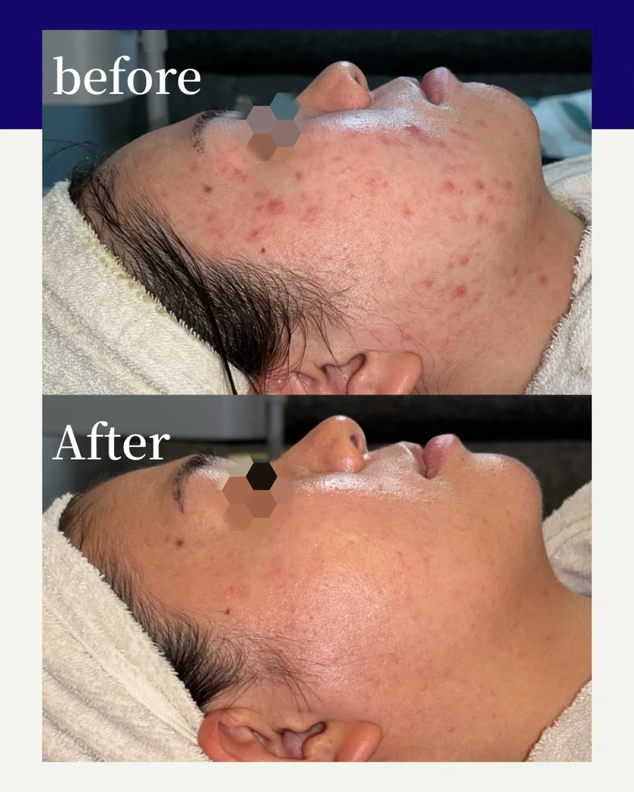 学生時代からニキビで悩むお客様BeforeAfter🪞