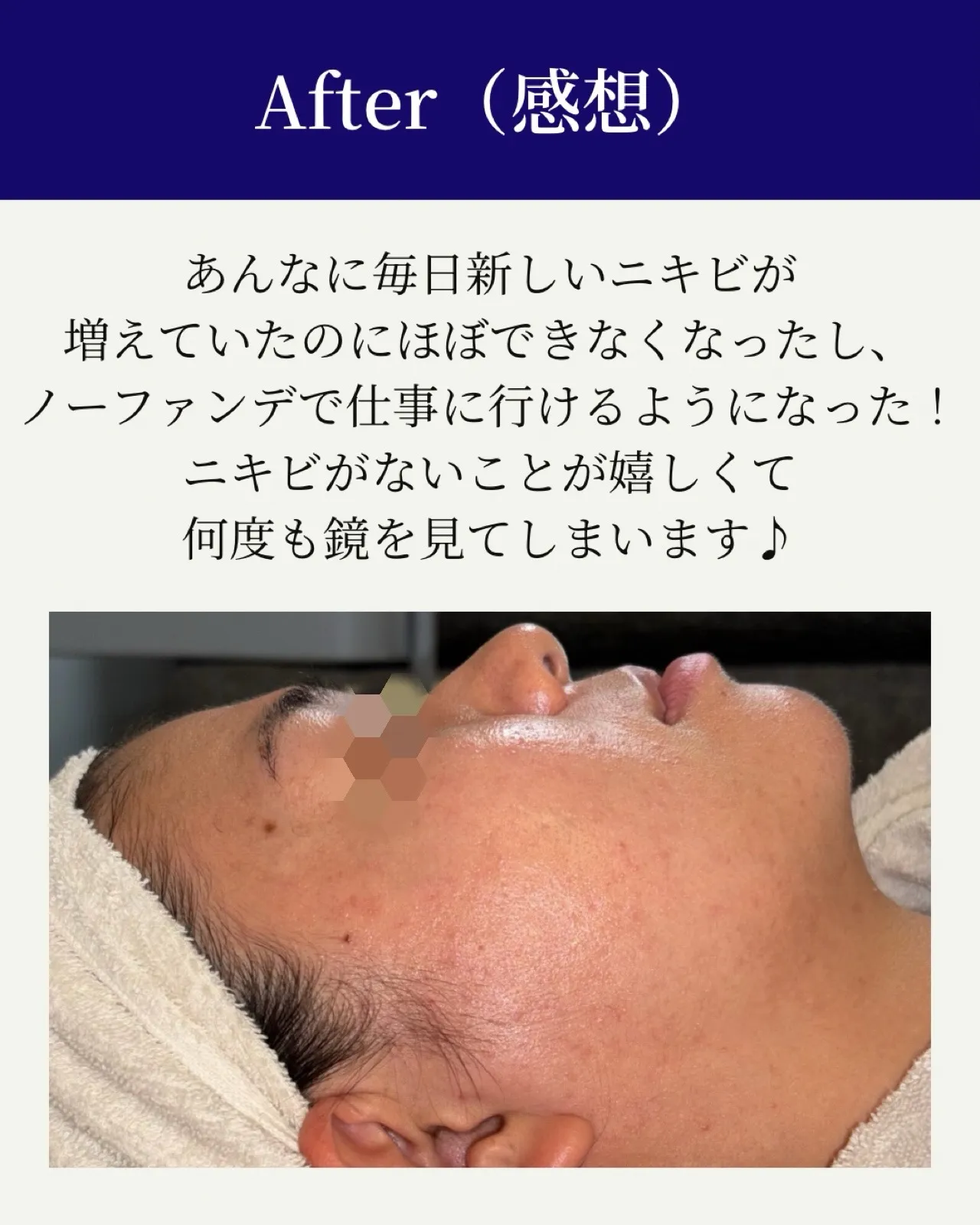 学生時代からニキビで悩むお客様BeforeAfter🪞