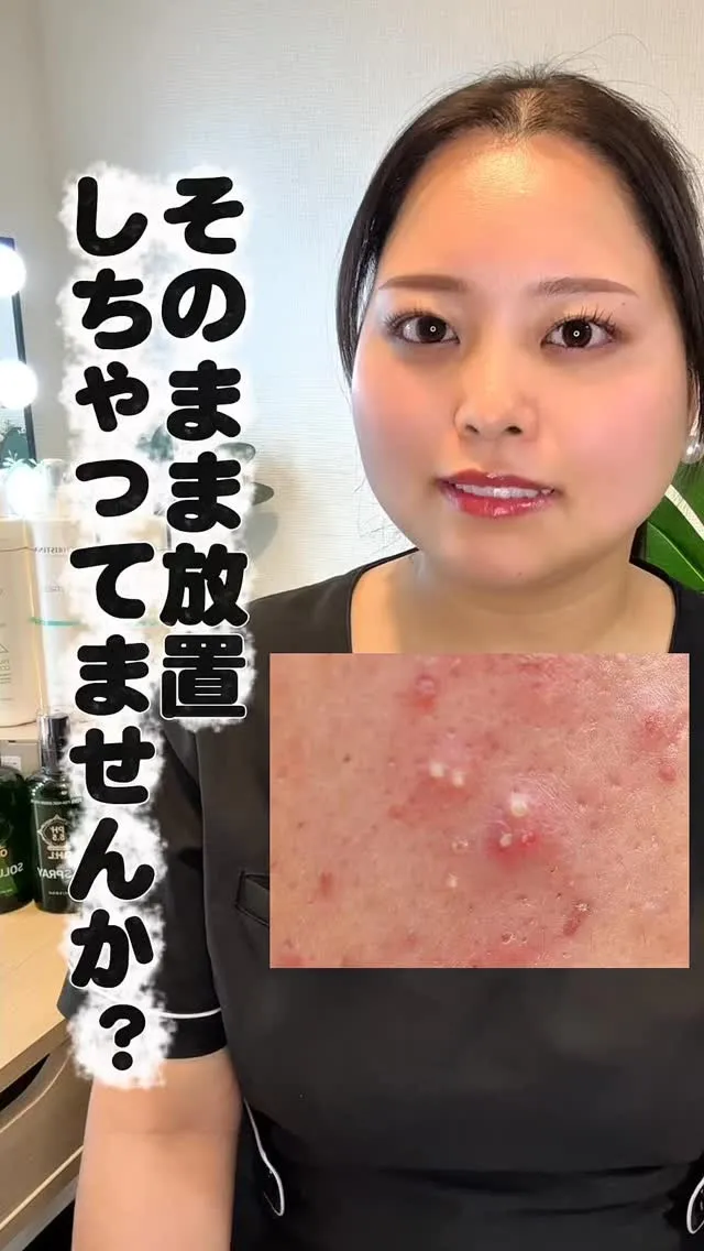 白ニキビ放置してませんか？